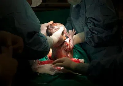 a baby just born by c-section